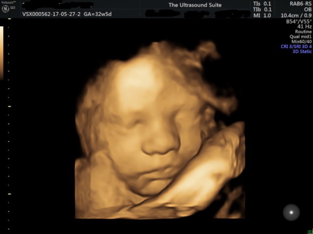 3D-ultrasound