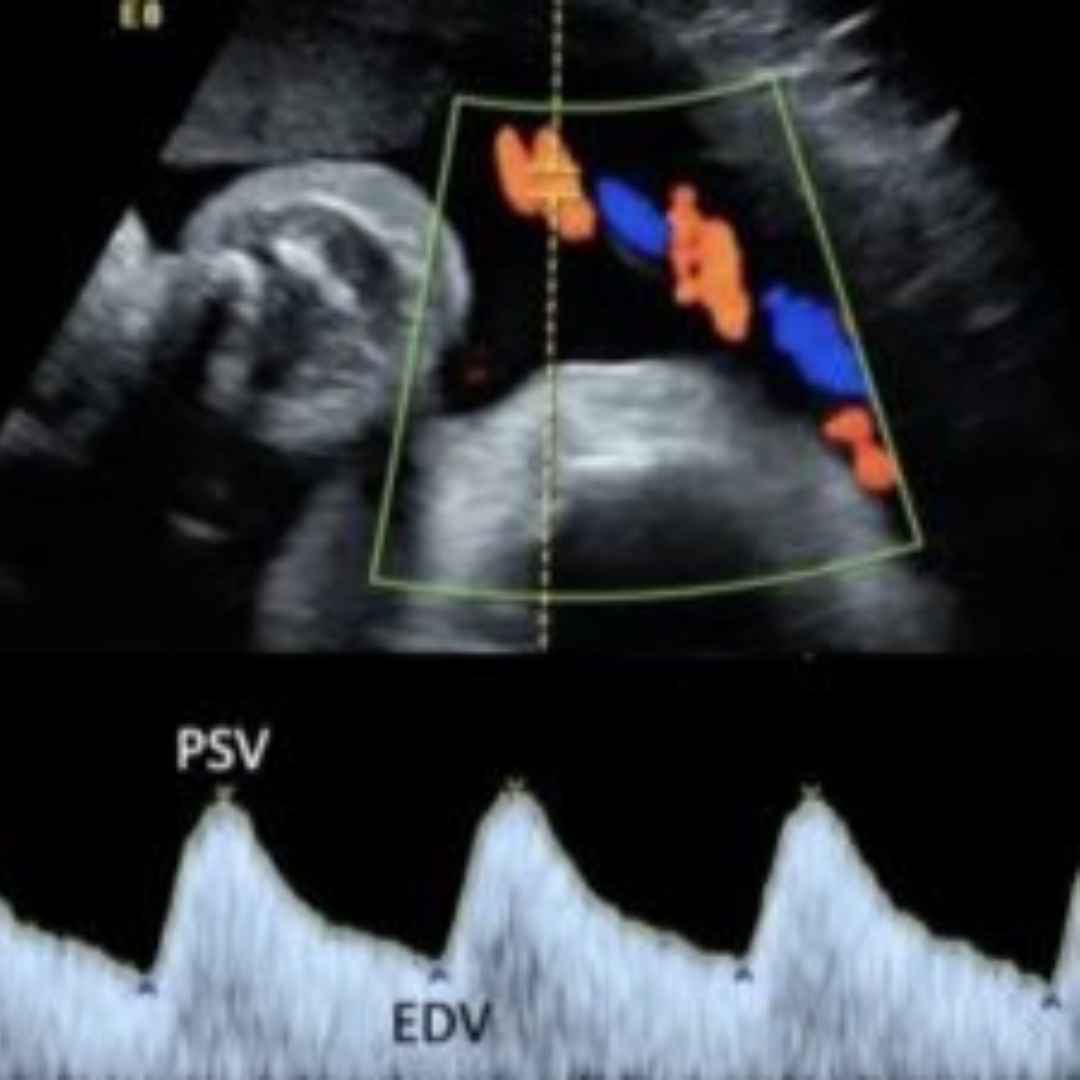 Obstetric Color Doppler Sonography