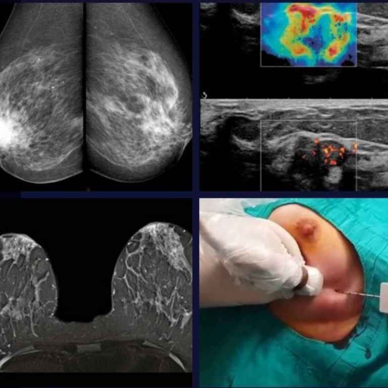 Breast Imaging & Intervention