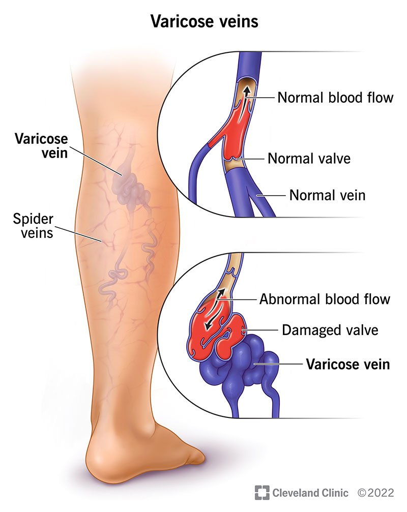 Varicose Veins