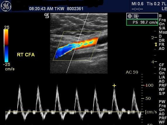Arterial Doppler
