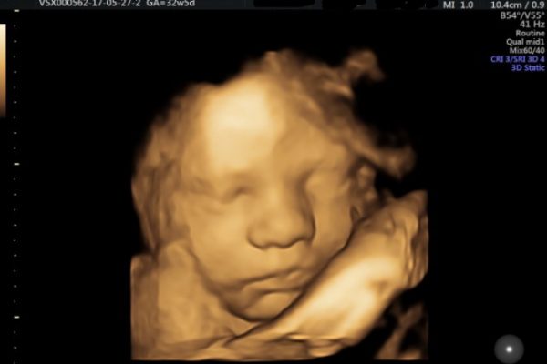 3D-ultrasound